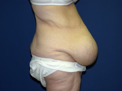 Circumferential Tummy Tuck Before & After Patient #898