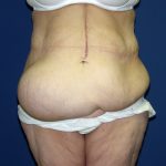 Circumferential Tummy Tuck Before & After Patient #898