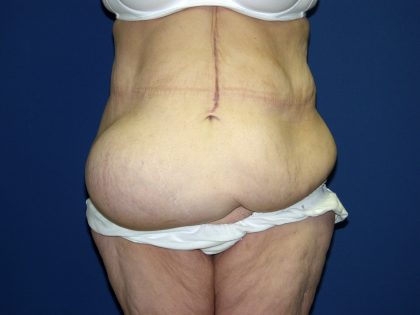 Circumferential Tummy Tuck Before & After Patient #898