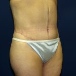 Circumferential Tummy Tuck Before & After Patient #898