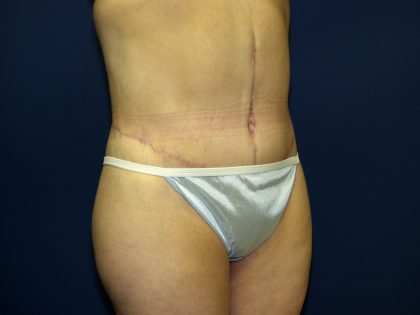 Circumferential Tummy Tuck Before & After Patient #898