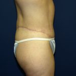 Circumferential Tummy Tuck Before & After Patient #898