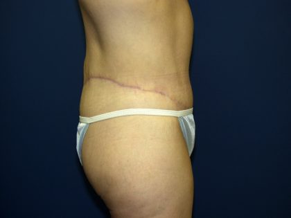 Circumferential Tummy Tuck Before & After Patient #898