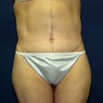 Circumferential Tummy Tuck Before & After Patient #898