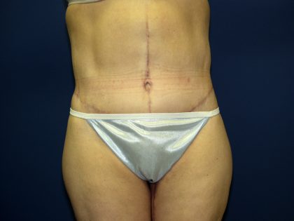 Circumferential Tummy Tuck Before & After Patient #898