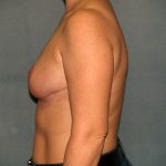 Breast Reduction Before & After Patient #3539