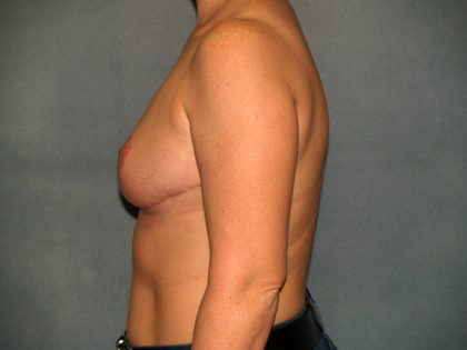 Breast Reduction Before & After Patient #3539