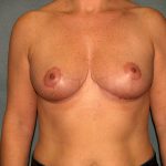 Breast Reduction Before & After Patient #3539