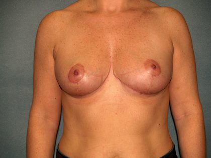 Breast Reduction Before & After Patient #3539