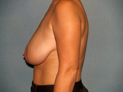 Breast Reduction Before & After Patient #3539