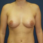 Breast Augmentation Before & After Patient #1580