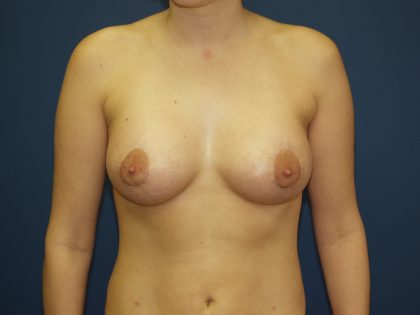 Breast Augmentation Before & After Patient #1580