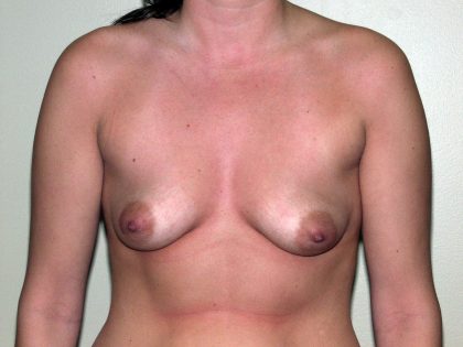 Breast Augmentation Before & After Patient #1580