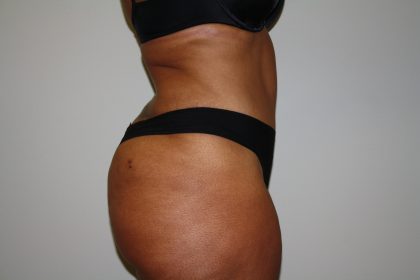 Tummy Tuck Before & After Patient #2344