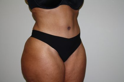 Tummy Tuck Before & After Patient #2344