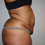 Tummy Tuck Before & After Patient #2344