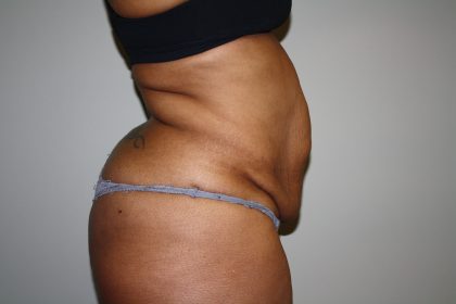 Tummy Tuck Before & After Patient #2344