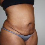 Tummy Tuck Before & After Patient #2344