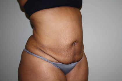 Tummy Tuck Before & After Patient #2344