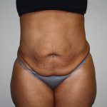 Tummy Tuck Before & After Patient #2344