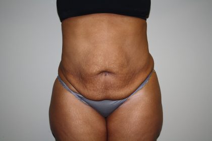 Tummy Tuck Before & After Patient #2344