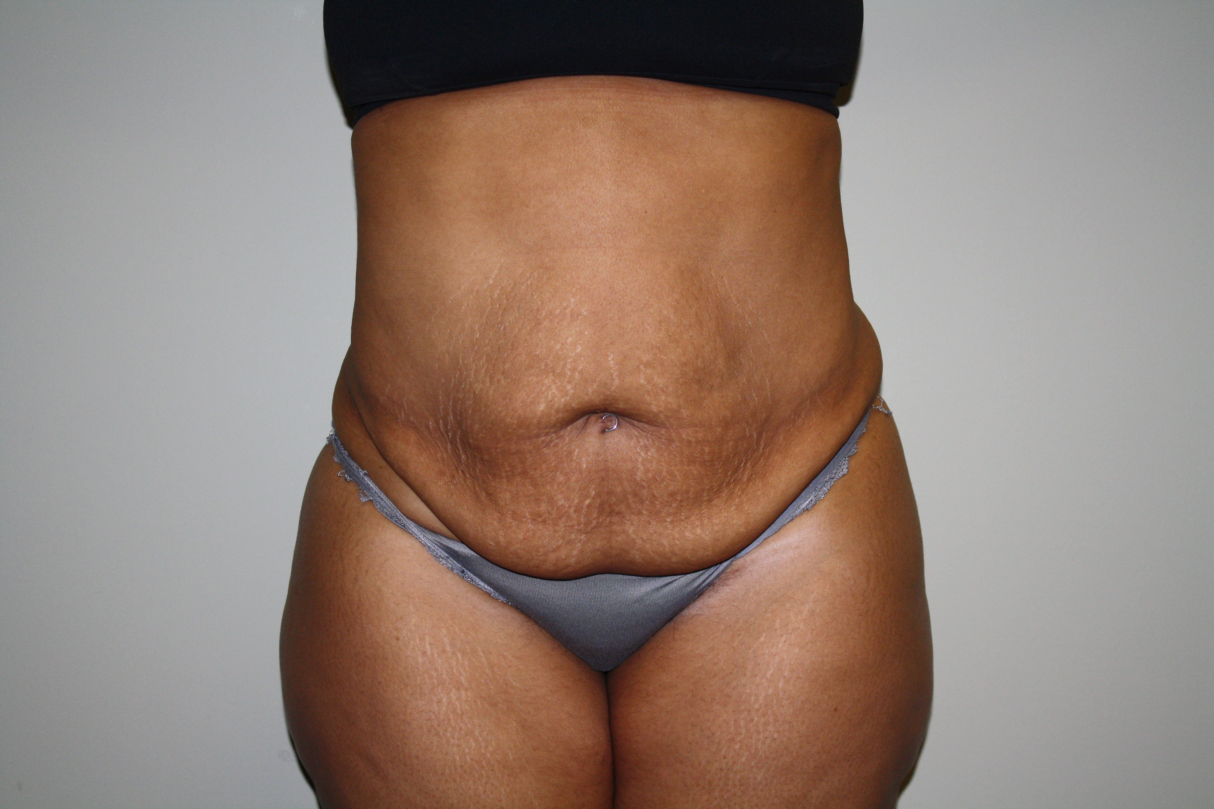 Tummy Tuck Before & After Patient #2344