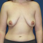 Breast Lift with Implant Before & After Patient #1418