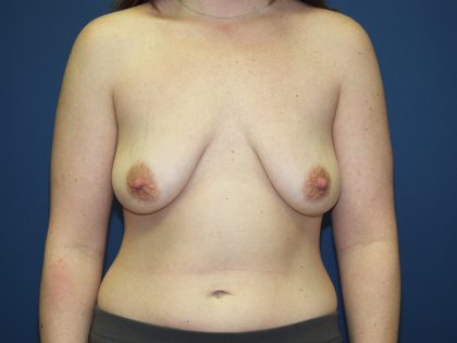 Breast Lift with Implant Before & After Patient #1418
