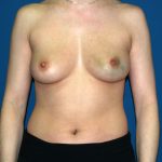 Breast Reconstruction Before & After Patient #2312