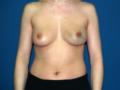 Breast Reconstruction Before & After Patient #2312