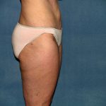 Liposuction Before & After Patient #3600