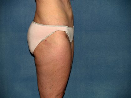 Liposuction Before & After Patient #3600