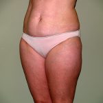 Liposuction Before & After Patient #3600