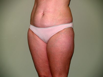 Liposuction Before & After Patient #3600