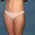 Liposuction Before & After Patient #3600