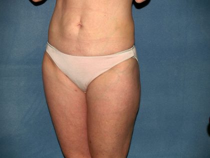 Liposuction Before & After Patient #3600