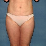 Liposuction Before & After Patient #3600