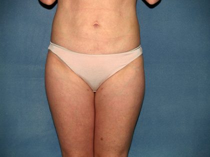 Liposuction Before & After Patient #3600