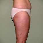 Liposuction Before & After Patient #3600