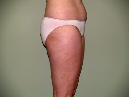 Liposuction Before & After Patient #3600