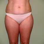 Liposuction Before & After Patient #3600