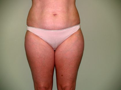 Liposuction Before & After Patient #3600