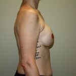 Breast Reconstruction Before & After Patient #1718
