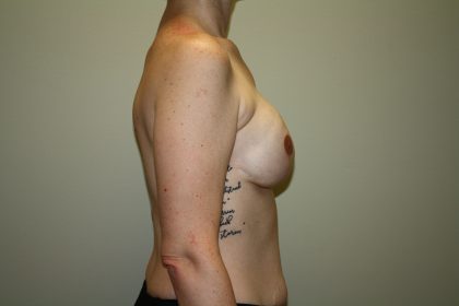 Breast Reconstruction Before & After Patient #1718