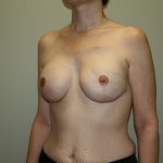 Breast Reconstruction Before & After Patient #1718