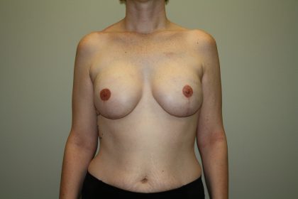 Breast Reconstruction Before & After Patient #1718