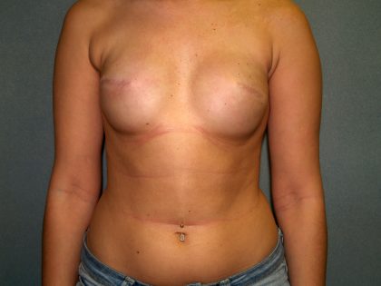 Breast Reconstruction Before & After Patient #1711