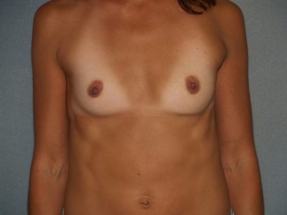 Breast Augmentation Before & After Patient #2619