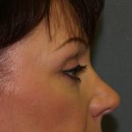 Eye Lid Lift Before & After Patient #676