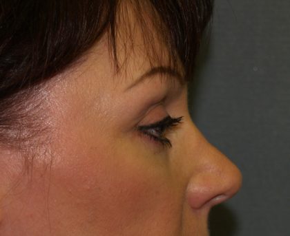 Eye Lid Lift Before & After Patient #676